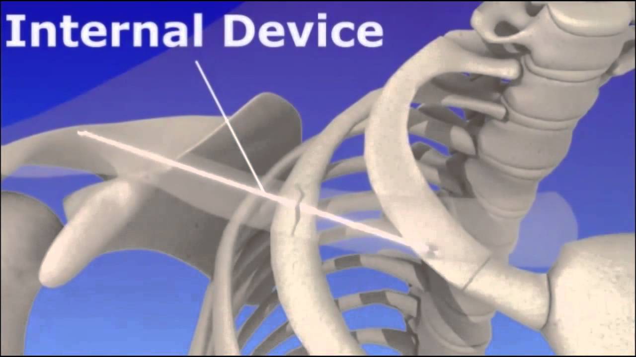 Clavicle Fracture - Broken Collar Bone - YouTube