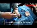 adult circumcision