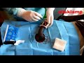 adult circumcision