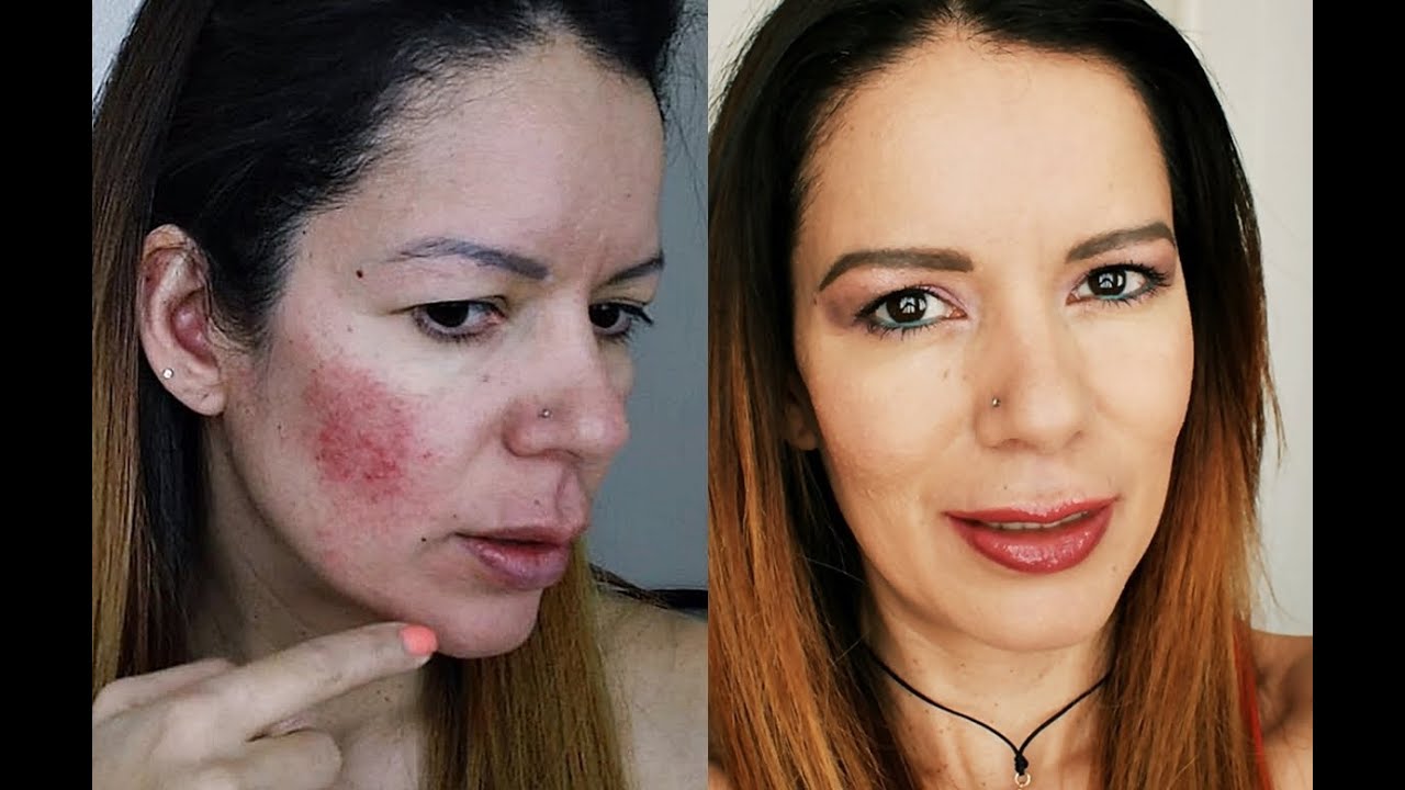 maquillaje antes y despues acne