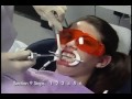 Beljenje zuba