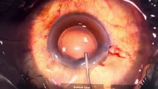 Direct Chop In Soft Cataract Ns 2