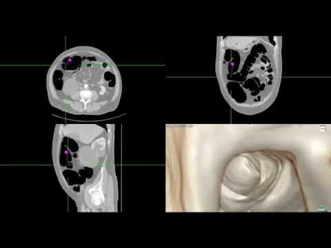 Ct Scan Abdominal Colonoscopy