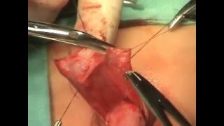 Distal Urethroplasty with Dorsal Dartos Flap
