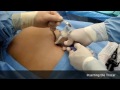 Gastric Banding Single Incision Surgery (Lap Band, Realize Band) by Dr Baptista