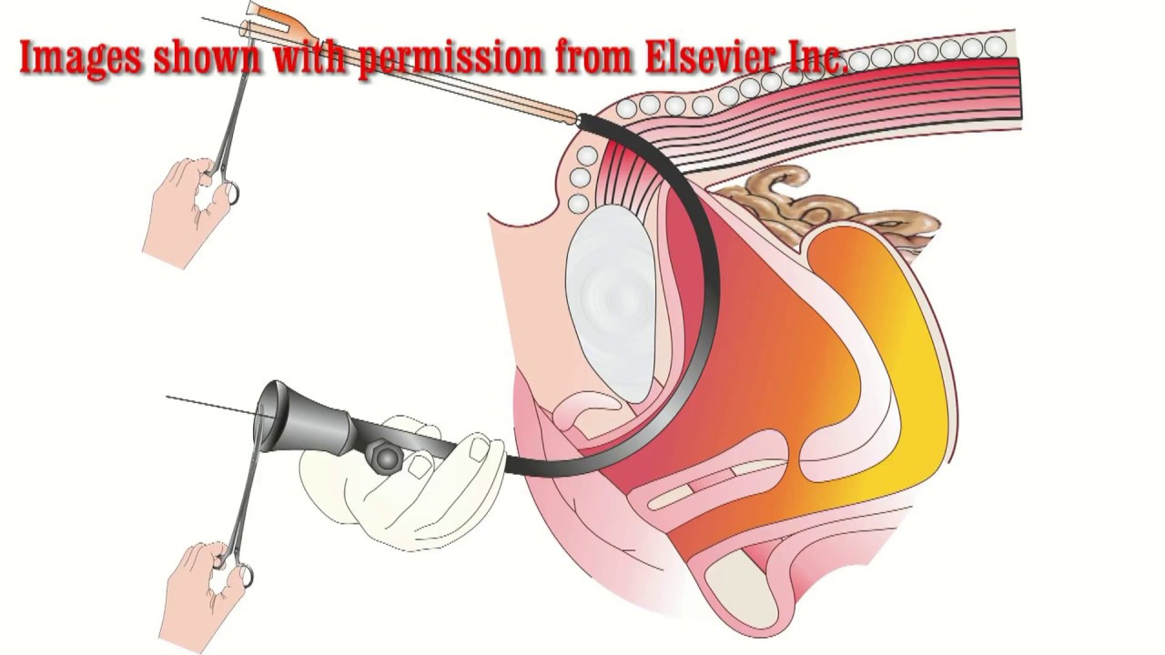 The second urethral stimulation sounding images