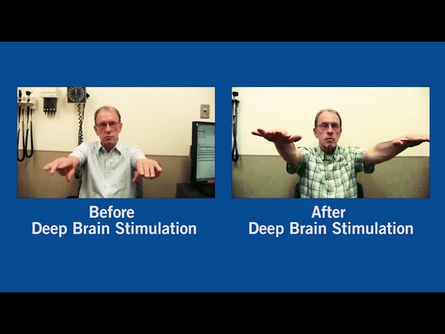 Watch Parkinson's Disease Before and After Deep Brain Stimulation on YouTube.