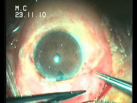 conjunctival conjunctiva outlines ocular known condition dr john trabeculectomy