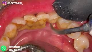 43 Yo. Females Teeth Tartar Dentist