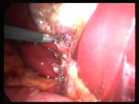 Single incision laparoscopic