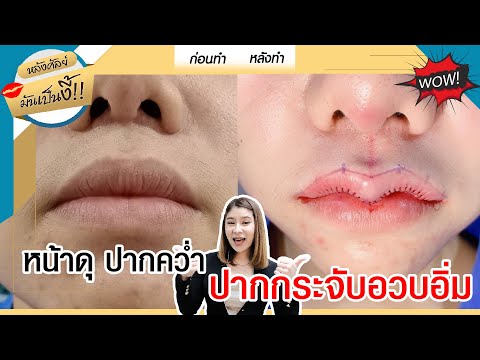 หลังศัลย์มันเป็นงี้! EP.12 I หน้าดุ ปากคว่ำ สู่ ปากกระจับอวบอิ่ม สวยละมุน ปังสุดในย่านนี้!!