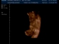 Rylens 32week ultrasound