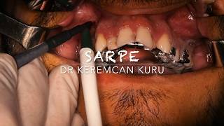 Sarpe Cerrahi Destekli Hızlı Üst Çene Genişletilmesi Üst Çene Ameliyatı