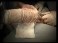 Penectomy