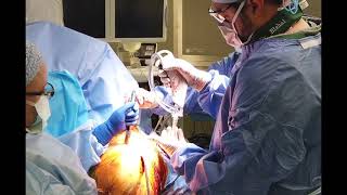 Humeral Head & Glenoid Reconstruction with Fresh Allograft After Fixed Anterior Shoulder Dislocation