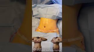 Tummy Tuck Before And After Dr. Zarrabi