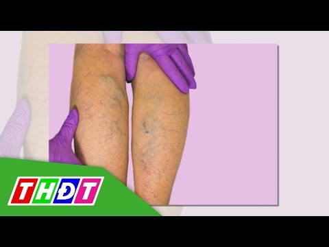 Suy giãn tĩnh mạch chân ở nữ giới | THDT
