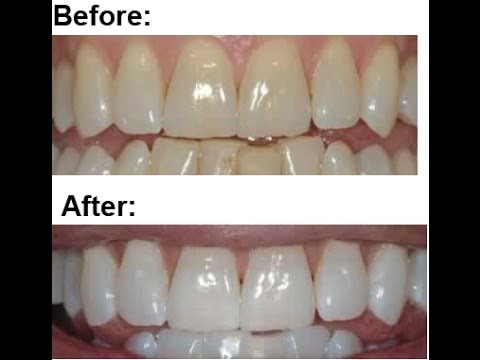 Best home teeth whitening with Stella White strips - YouTube