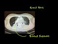 Vaping / E-Cigarette Lung Failure, Illness, Disease Outbreak