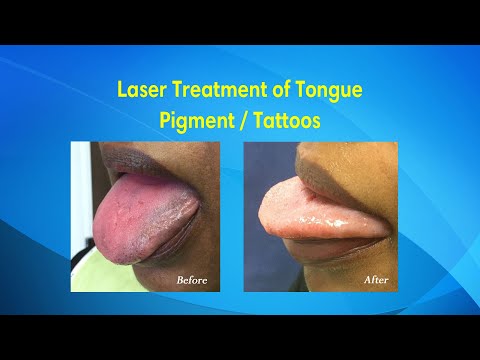 tongue tattoo removal