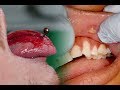 The Problem with Tongue Piercings 👅 Risks, Complications, Tips!