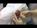 elbow abscess
