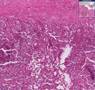 Histopathology Lung--Abscess, bronchopneumonia