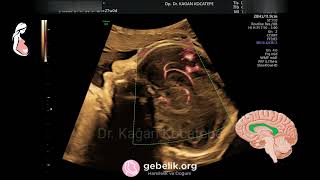 Fetusta ultrasonda corpus callosum nasıl görülür ve ölçülür? Perikallozal arterler yardımcı olabilir