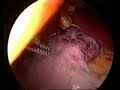 Biliopancreatic Diversion