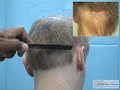Bad hair surgery outcome: FUE - BHT repair of the worst case Part 1 of 3