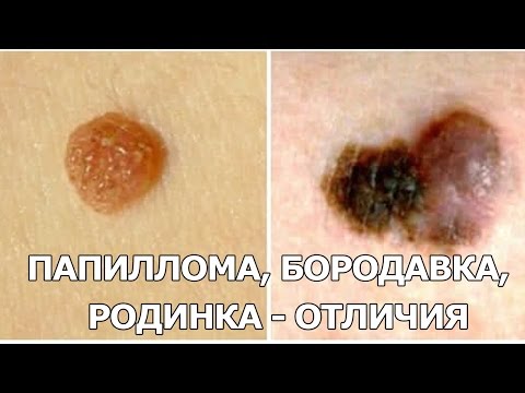 Бородавка или невус Бородавка или невус