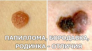 dumayu chto priznak borodavki perviy i papillomi prosheniya chto vas Бородавки и папилломы первый признак фото
