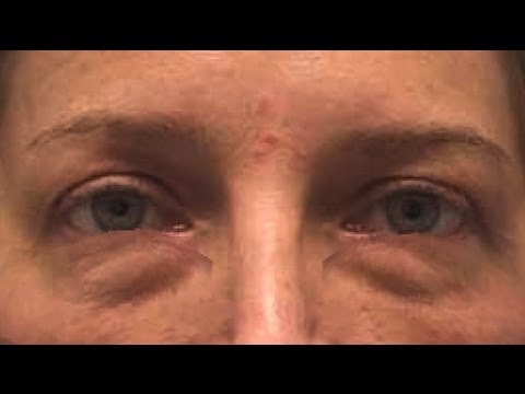 Мешки под глазами у беременных 12