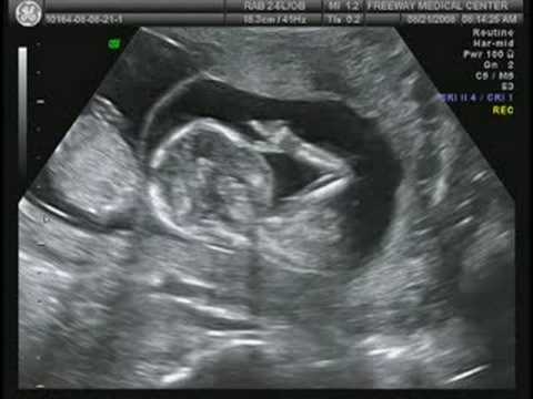 lost twins at 13 weeks lost twins at 13 weeks