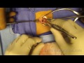 Hernia repair surgery- umbilical hernia