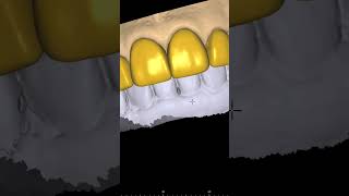 Veneers Design