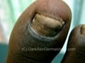 Onychomycosis.wmv