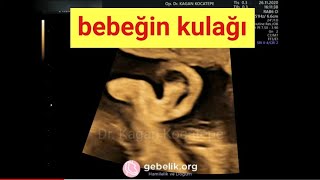 Ultrasonda anne karnındaki bebeğin kulakları nasıl görünür? (28 haftalık gebelik)