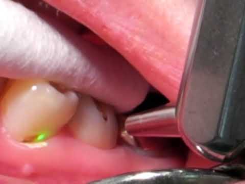 Cervical Hypersensitivity ADR-dental