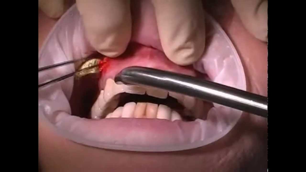 Йодоформные турунды как сделать Йодоформные турунды как сделать