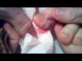 Part 2 GIANT PIMPLE CYST POP ON TOE PART 2 - The Popping