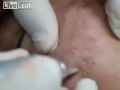 Extreme Acne Treatment, Laser and Pus Fly Widely