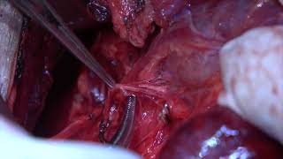 Thyroidectomy For Mive Goiter