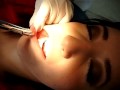 TÉCNICAS DE ANESTESIA DENTAL Parte 2 ODNTOLOGÍA UJED