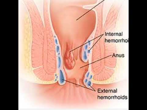 Swollen left anus under skin