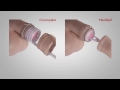 A comparison of Circumplast® and Plastibell® Circumcision Devices