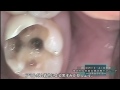 【歯科】Dr.ロバート・A・ロウ審美的な虫歯自費診療テクニック