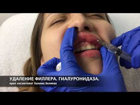 Удаление геля из губ. ГИАЛУРОНИДАЗА ЛИДАЗА Удаление геля из губ. ГИАЛУРОНИДАЗА ЛИДАЗА