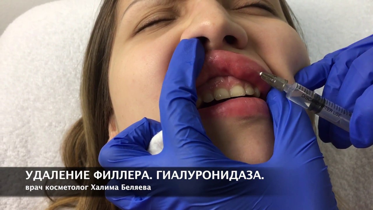 Я удаляла биополимерный гель из губ Я удаляла биополимерный гель из губ