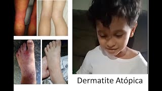 Gabriel - Dermatite Atópica